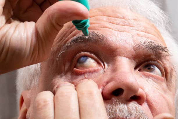 Elderly applying eye drops to cataract