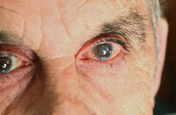 Senior suffering from glaucoma