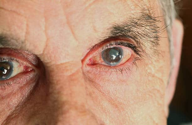 Senior suffering from glaucoma.