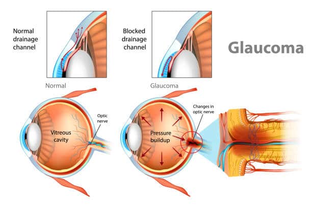 Comparison between normal vision vs glaucoma.