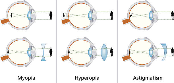 Illustration of vision disorders.
